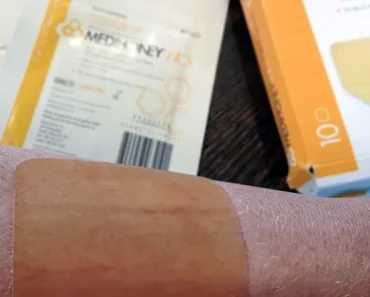 Can Manuka Honey Really Help Heal Minor Burns? Can Manuka Honey Really Help Heal Minor Burns?